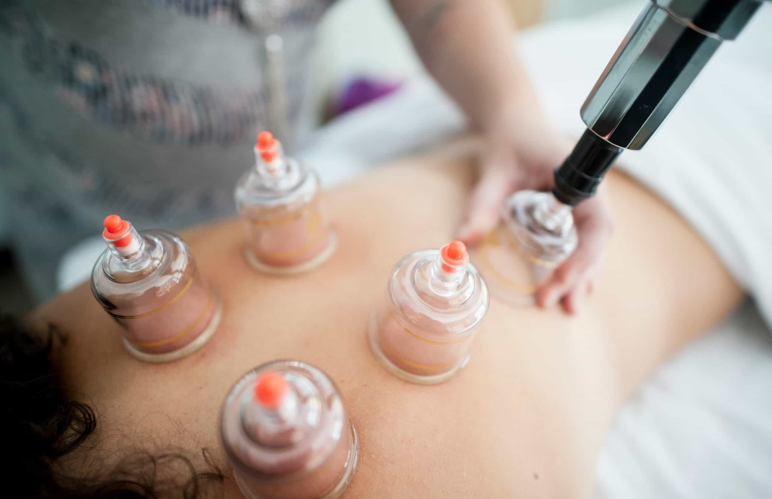 Best Cupping Sets for Muscle Tension in 2026: Suction Types, Marks, and What the Evidence Says
